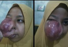 Siswa Penderita Tumor Maksila Mendapat Bantuan Asum PTPN 5 Sei Rokan