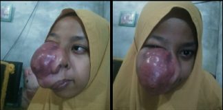 Siswa Penderita Tumor Maksila Mendapat Bantuan Asum PTPN 5 Sei Rokan
