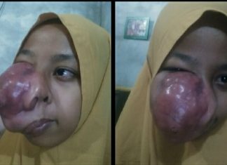 Siswa Penderita Tumor Maksila Mendapat Bantuan Asum PTPN 5 Sei Rokan
